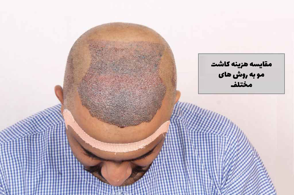 مقایسه هزینه کاشت مو به روش های مختلف 1402