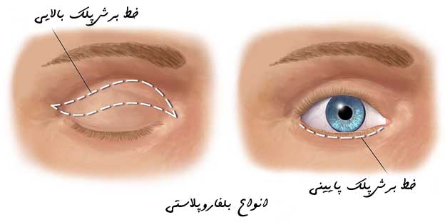 انواع بلفاروپلاستی