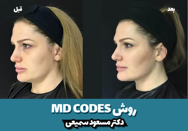 قبل و بعد روش MA Codes 2