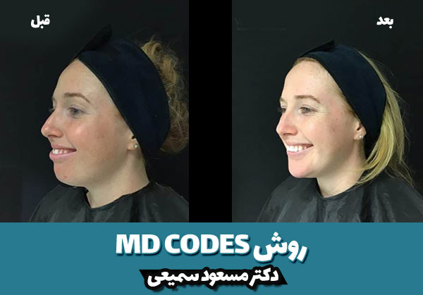 قبل و بعد روش MA Codes