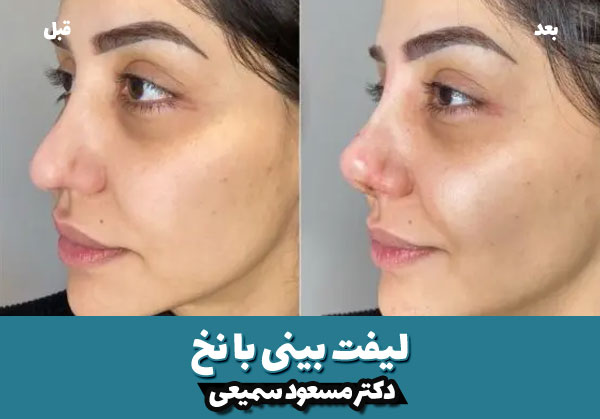 هزینه لیفت بینی با نخ 4 قبل و بعد لیفت بینی با نخ 2