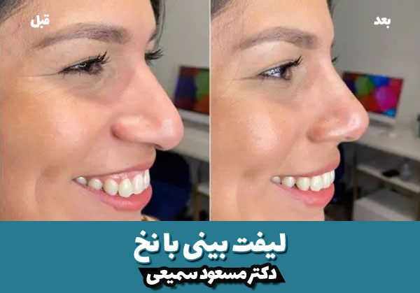 هزینه لیفت بینی با نخ 5 قبل و بعد لیفت بینی با نخ 3
