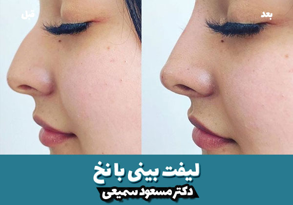 هزینه لیفت بینی با نخ 6 قبل و بعد لیفت بینی با نخ 4