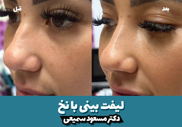 هزینه لیفت بینی با نخ 3 قبل و بعد لیفت بینی با نخ