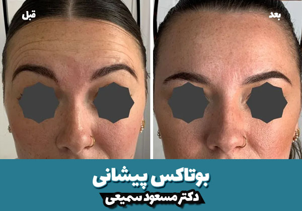 مراقبت های بعد از بوتاکس پیشانی 4 بوتاکس پیشانی قبل و بعد 2