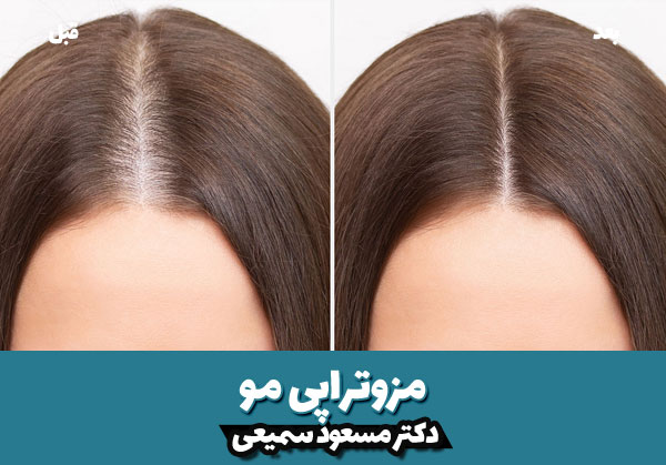 قیمت مزوتراپی مو 1404 4 قبل و بعد مزوتراپی مو 2