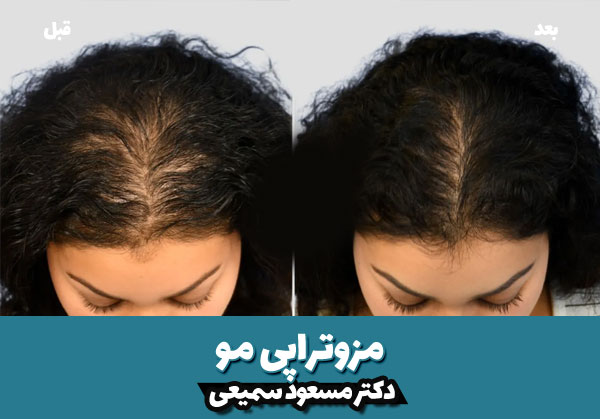 قیمت مزوتراپی مو 1404 3 قبل و بعد مزوتراپی مو