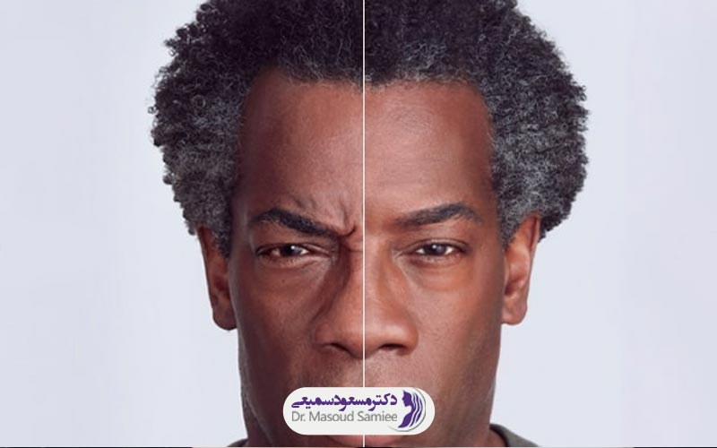 مراقبت های بعد از بوتاکس پیشانی 1 مراقبت های بعد از بوتاکس پیشانی